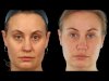 The Process of Under Eye Fillers at the Best Aesthetic Clinic in Dubai