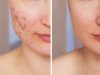 Clear Skin Journey: A Natural Approach to Managing Acne