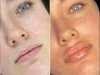 Sculpt Your Face with Fillers Treatment in Dubai