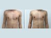 Gynecomastia in Dubai: What to Expect Before and After