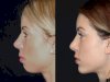 Chin Fillers in Dubai Can Boost Your Confidence and Appearance