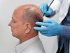 Hair Transplant Procedure for Hair Loss Treatment in Men