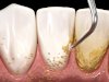 Scaling of Teeth What It Is, Why It’s Important, and How It Improves Your Oral Health