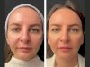 Top Reasons to Choose Mesotherapy at the Best Aesthetic Clinic in Dubai