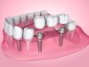 Reclaim Your Confident Smile with Dental Bridges in York: What You Need to Know