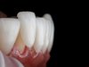 The Role of Dental Veneers in Cosmetic Dentistry: Trends and Innovations