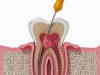 Root Canal Treatment Specialist Near Me: Expert Tooth Care at Dr. Neetu’s Multi Speciality Dental Clinic, Panchkula