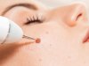Skincare Routine After Warts Removal in Islamabad