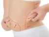 How to Estimate Your Liposuction Cost in Dubai Accurately