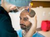 How Hair Transplants Have Evolved Over the Last Decade