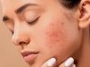What is the Most Effective Treatment for Acne?