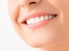 How Teeth Whitening Cost Matches Expectations