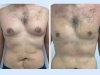 Post-Surgery Care for Gynecomastia in Dubai Guided by Best Surgeons