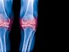 Is Sclerosis the Same as Osteoarthritis? Here’s What You Need to Know 