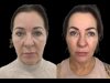 Best Doctors in Dubai for Profhilo: Addressing Common Concerns and Myths