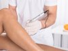 How MCA Microneedling Targets Stretch Marks for Visible Skin Renewal