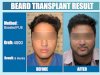 Understanding the Need for Beard Hair Transplant