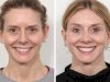 Advanced Thread Lift Techniques at the Best Aesthetic Clinic in Dubai