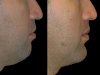 A Step-by-Step Guide to Chin Fillers with the Best Plastic Surgeon in Dubai