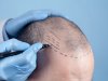 Can You Get a Crown Hair Transplant at Age 25?