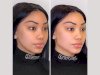 Comparing Facelift vs. Thread Lift Treatment in Dubai