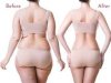 Sculpt Your Best You: Expert Body Contouring, Liposuction & 6-Pack Abs Surgery in Gurgaon