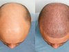 فوائد زراعة الشعر في الرياض مقارنة بالعلاجات الأخرى