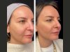 Mesotherapy Treatment in Dubai for Glowing Skin: How It Works