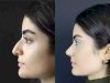 Can the Best Rhinoplasty Surgeon in Dubai Achieve Subtle Enhancements?