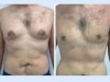 Gynecomastia in Dubai: Choosing the Right Surgeon for You