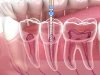 How Long Does It Take to Heal After Root Canal Treatment?