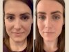 PRP Treatment in Dubai: What to Expect During Your First Session
