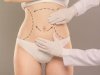 Tummy Tuck for Stretch Marks Reduction in Islamabad