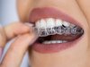 Dental Appliances for TMJ Disorders