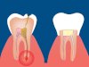 Can a Root Canal Treatment Prevent Future Tooth Pain?