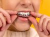 Do You Need Retainers After Invisalign Braces Treatment?