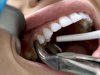 Are Tooth Extractions Cheaper Than Root Canals?