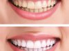 Fast Teeth Whitening Solutions in Islamabad