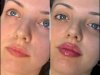 Best Plastic Surgeons in Dubai for Fillers with Natural Outcomes