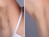 Electrolysis Laser hair removal treatments in dubai: Say Goodbye to Shaving