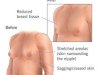 Tips to Manage Gynecomastia Surgery Cost in Islamabad Without Compromising Safety