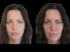 Best Plastic Surgeons in Dubai for Jawline Perfection with Jawline Fillers