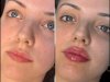 Best Aesthetic Clinics in dubai for Fillers Expert Touch for Flawless Skin