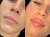 Dermal Fillers in Dubai for a Fresh and Radiant Look