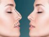 Celebrity-Inspired Rhinoplasty: Natural Looks Without Overdoing It