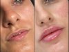 Best Plastic Surgeons in Dubai for Fillers and Stunning Jawline Definition