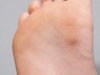 Wart vs Corn: Everything Athletes Need to Know