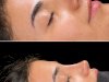 How Rhinoplasty in Islamabad Combines Medical Knowledge With Aesthetic Vision