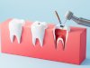 What Happens If You Delay Root Canal Treatment for an Infected Tooth?
