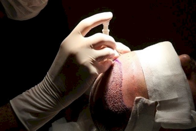 Best Hair Transplant Clinics Near Islamabad’s Medical Centers
